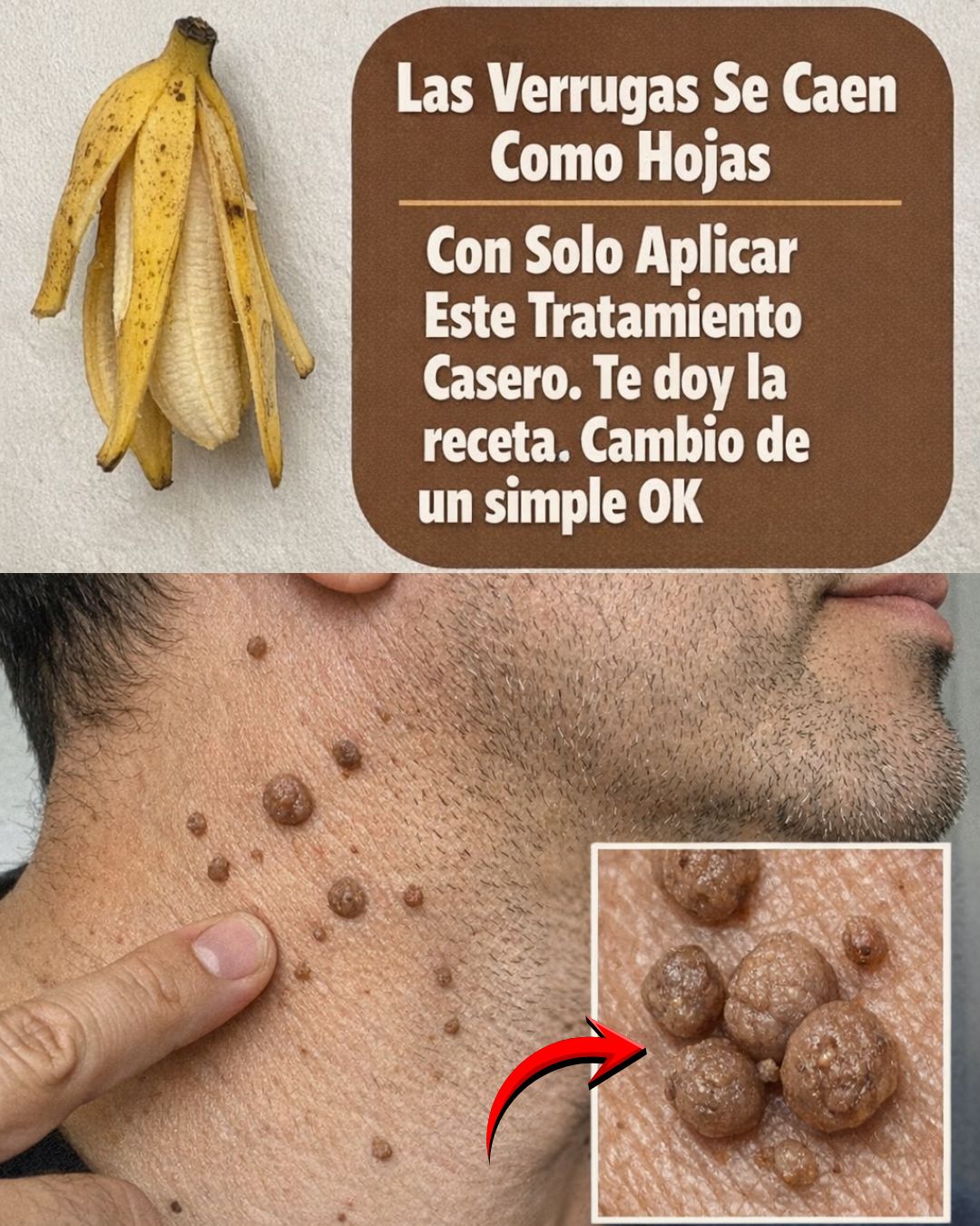 ¡Cáscara de Plátano para borrar la verruga!