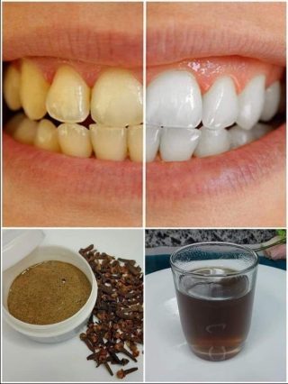 Sbiancamento dei denti: 7 metodi comprovati per eliminare definitivamente i denti gialli!