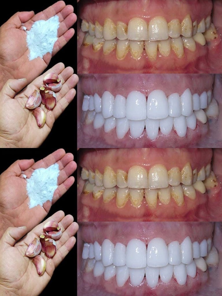 Come sbiancare i denti in 2 minuti?