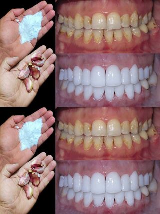 Come sbiancare i denti in 2 minuti?
