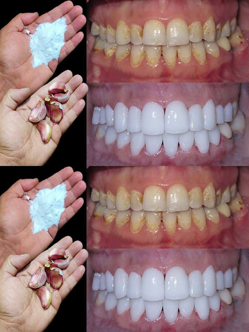 Come sbiancare i denti in 2 minuti?