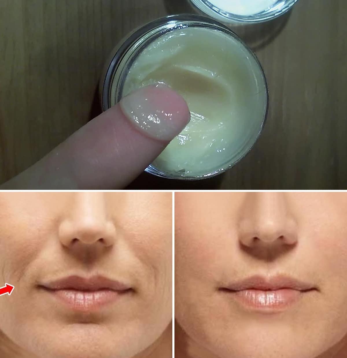 Linea di sorriso: 2 crema fatta per rimuovere la pala.
