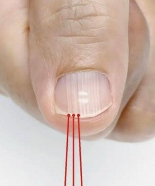Cosa possono rivelare queste striature verticali sulle unghie, soprattutto dopo i 40 anni?