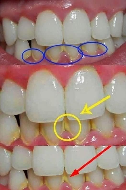 Rimuovi la placca dentale in modo naturale in 5 minuti, senza bisogno di andare dal dentista.